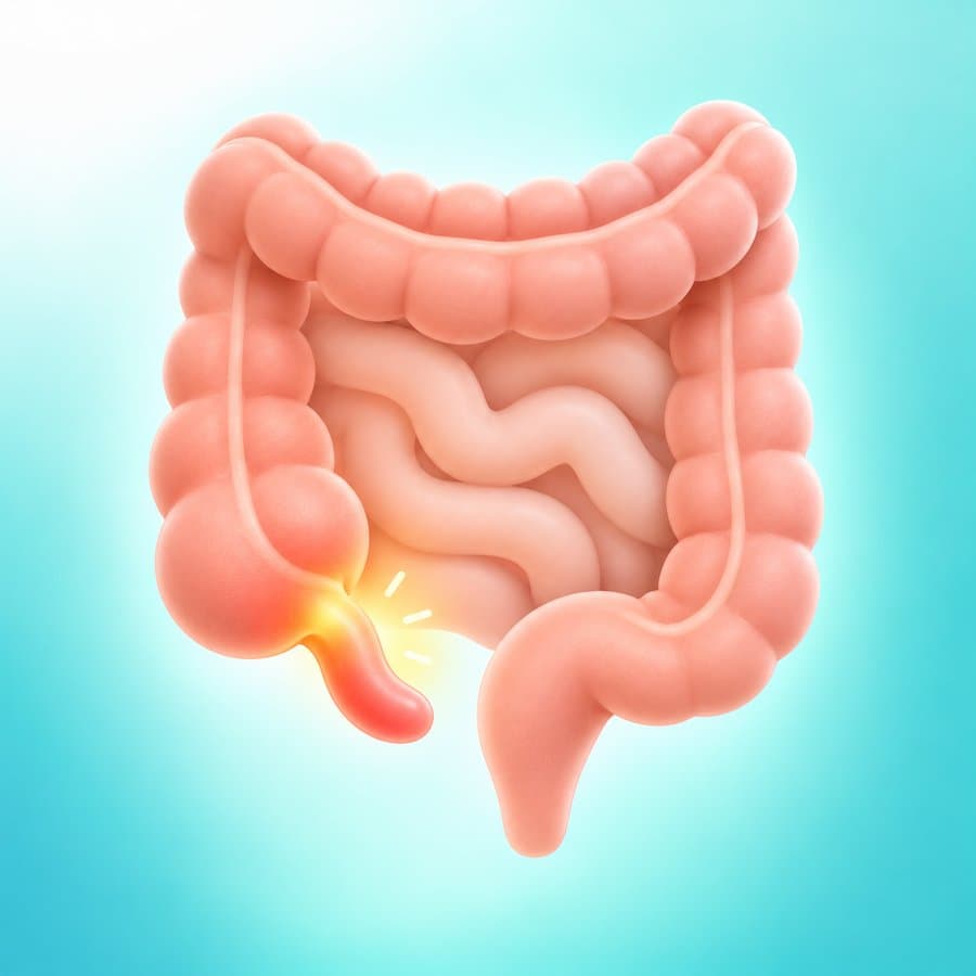 Illustration of a child's large intestine with an inflamed, red appendix highlighted