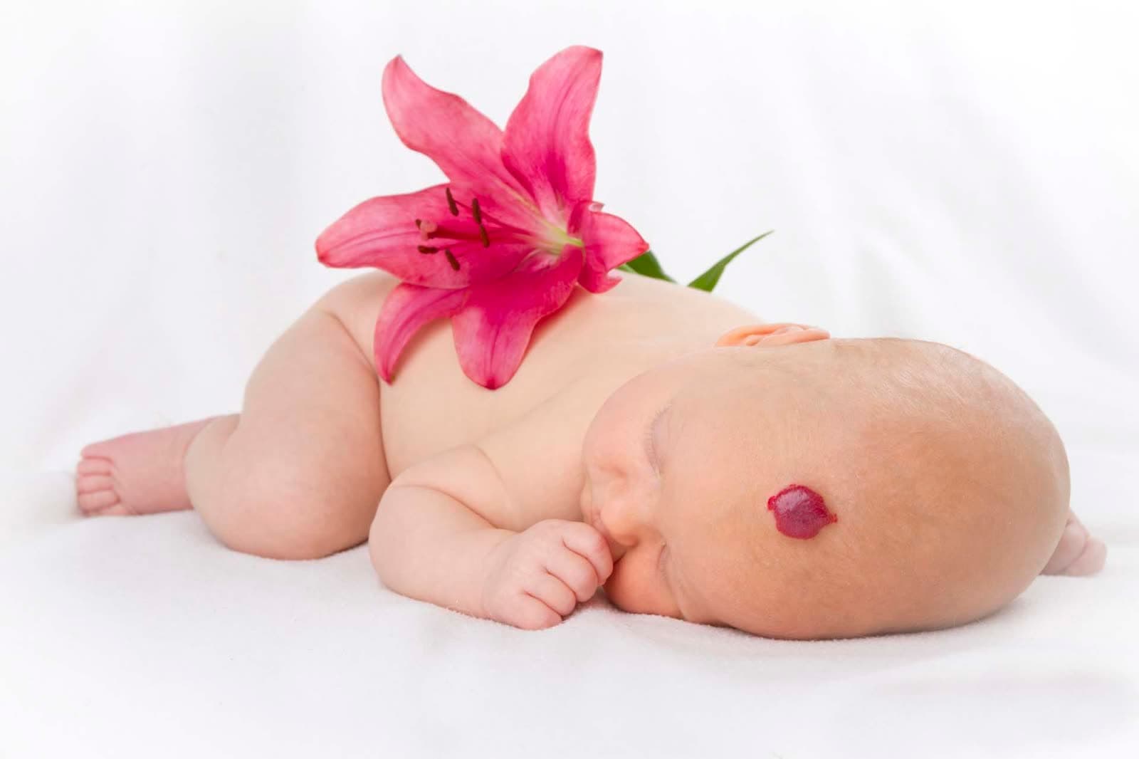 little baby with hemangioma
