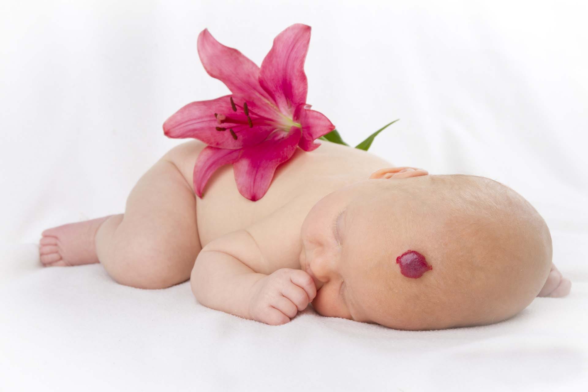little baby with hemangioma