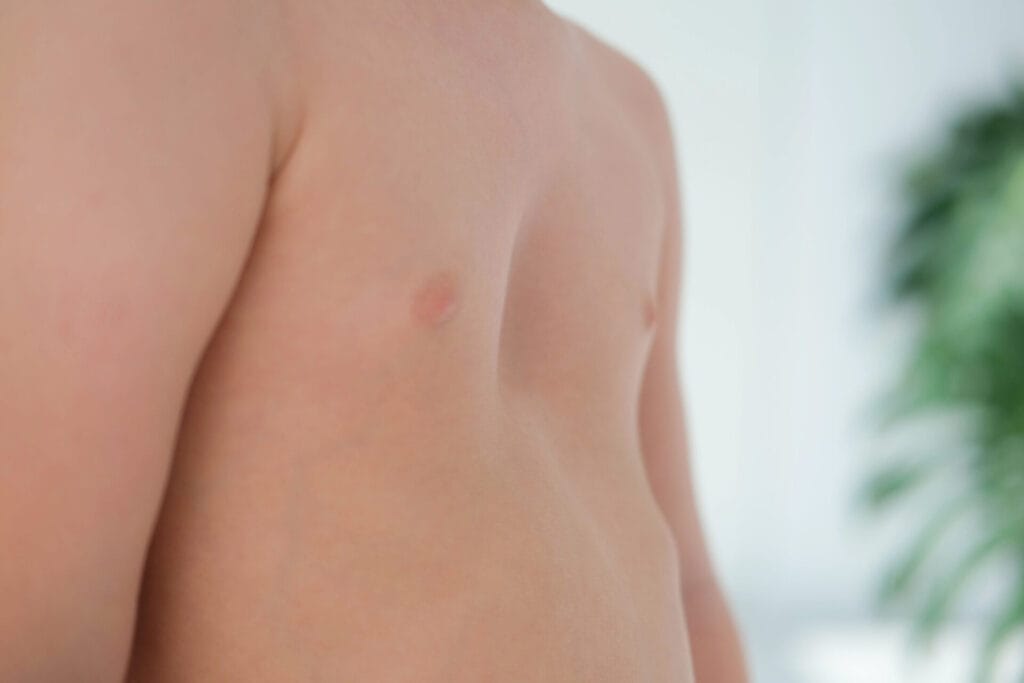 A child with a pectus excavatum. Rickets is a consequence of vitamin D deficiency.