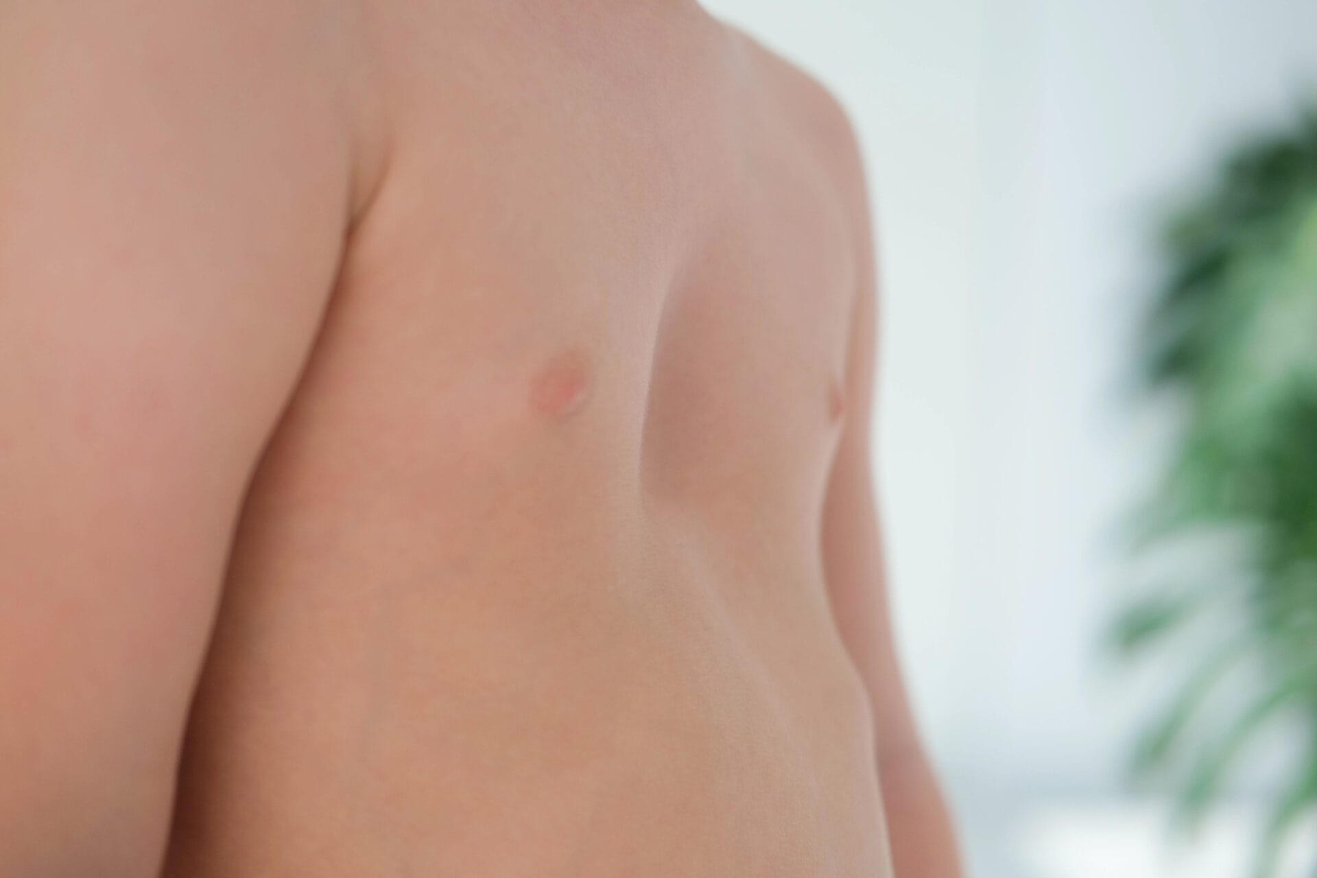 A child with a pectus excavatum. Rickets is a consequence of vitamin D deficiency.
