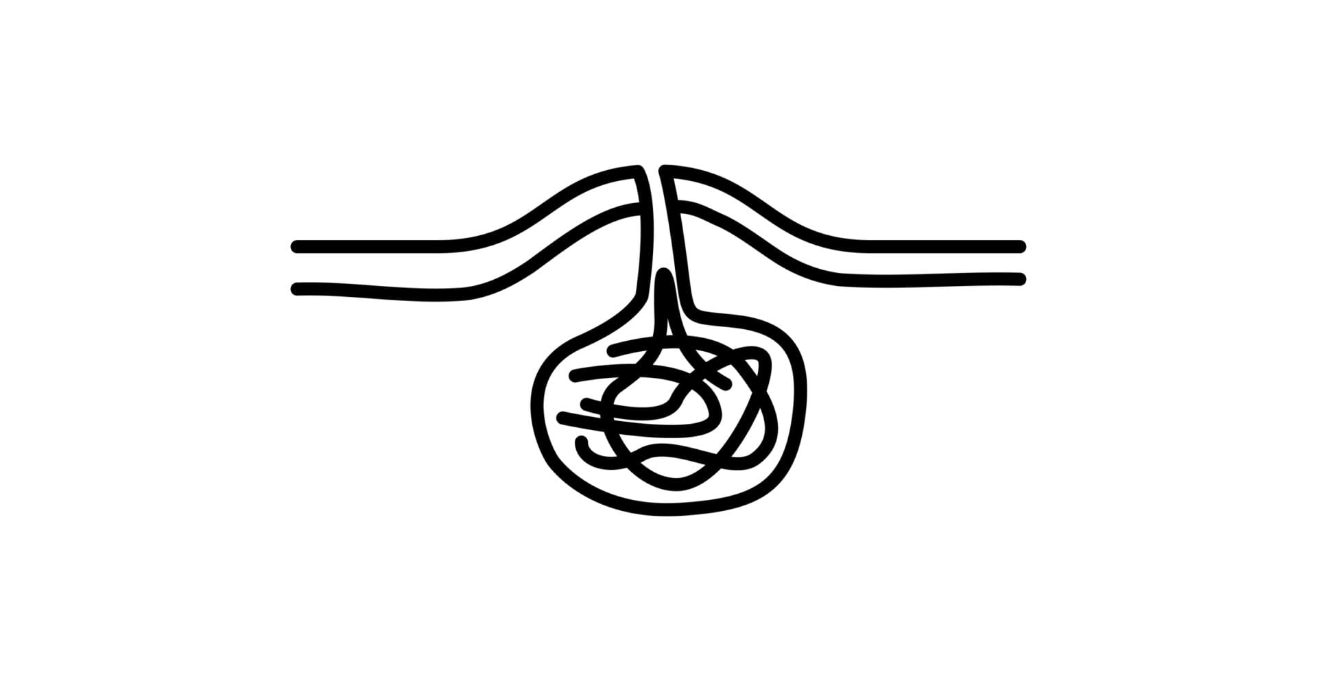 vector illustration of a pilonidal cyst