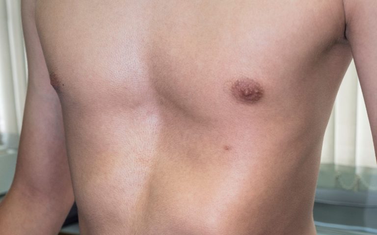 A child with a chest wall deformity in Conejo Valley