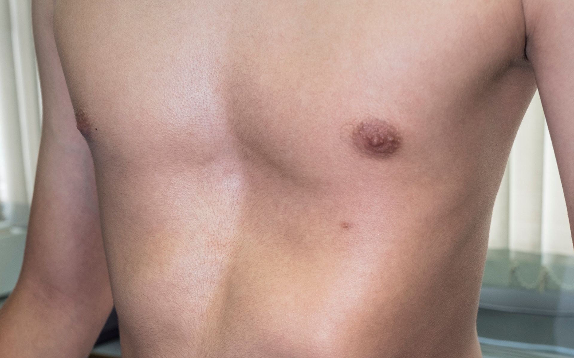 A child with a chest wall deformity in Conejo Valley